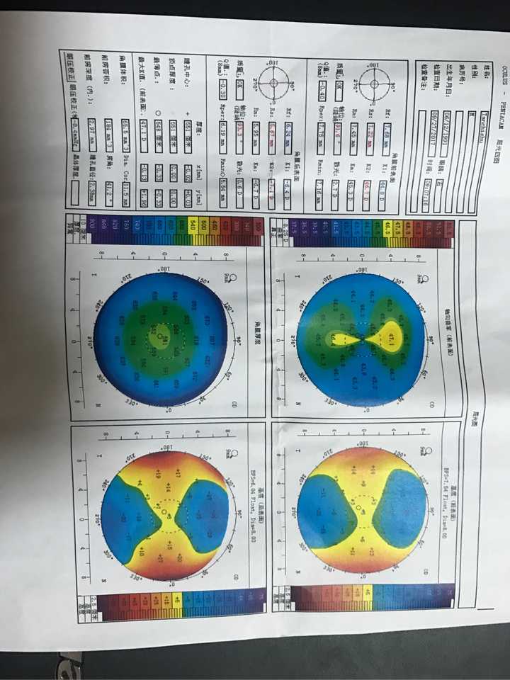 请大神看一下角膜地形图,是不是不规则散光,晚上看东西上下重影?