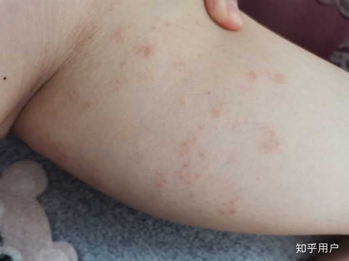糠疹玫瑰的注意以及平时要自愈的?骨头炖斤酸菜冻豆腐红shudou图片