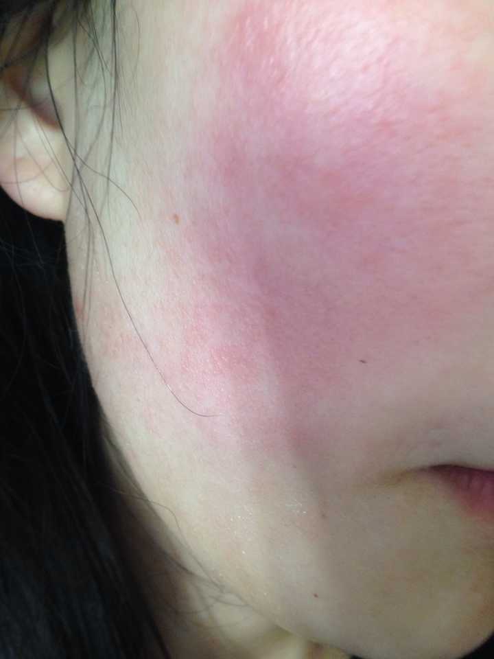 光子嫩肤的效果如何?