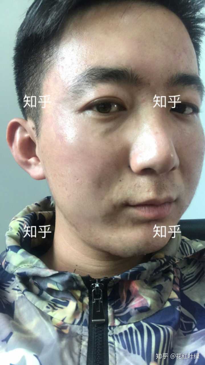 腮帮子两侧长痘痘,反反复复,怎么办?