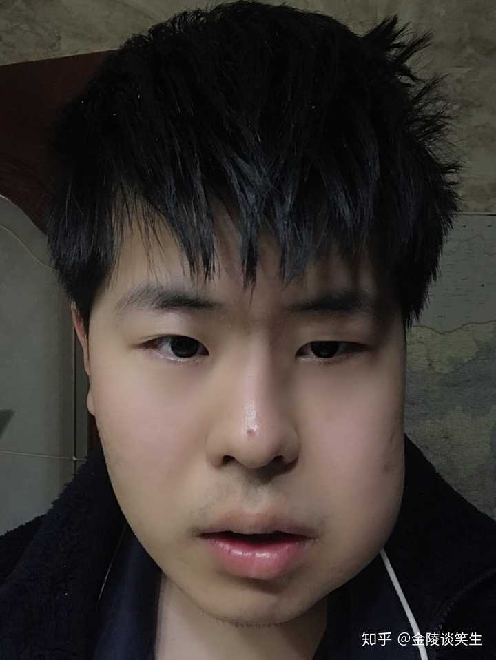 拔水平阻生智齿,术后第二天脸肿了,请问几天能消肿?