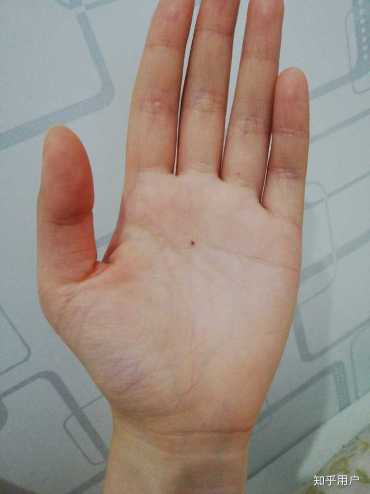掌心有痣是什么体验?