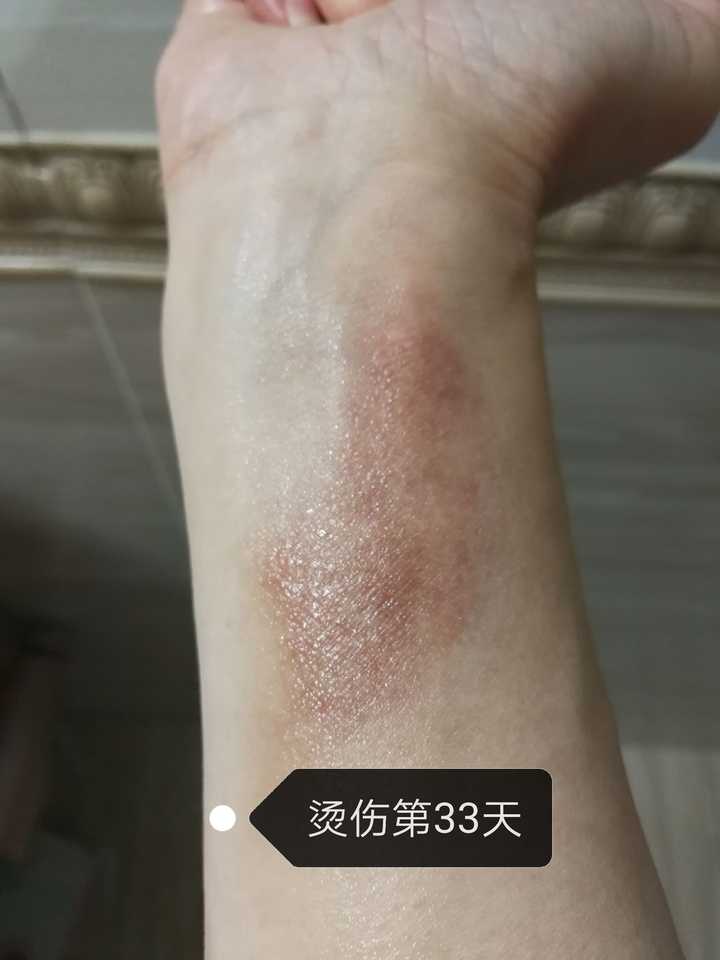 烫伤前后皮肤的具体变化是怎样的?
