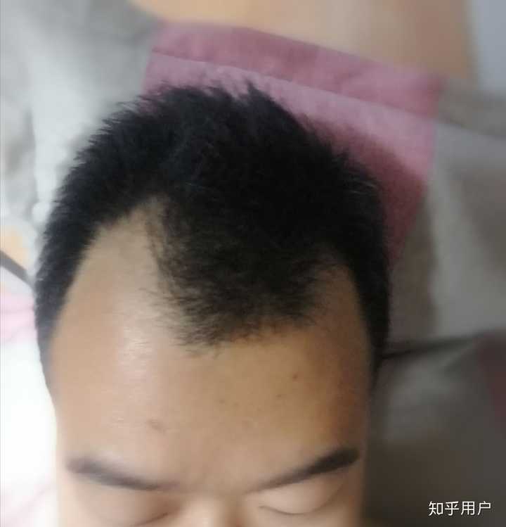 发际线高且m型发际线的男人适合什么发型?额头较大?