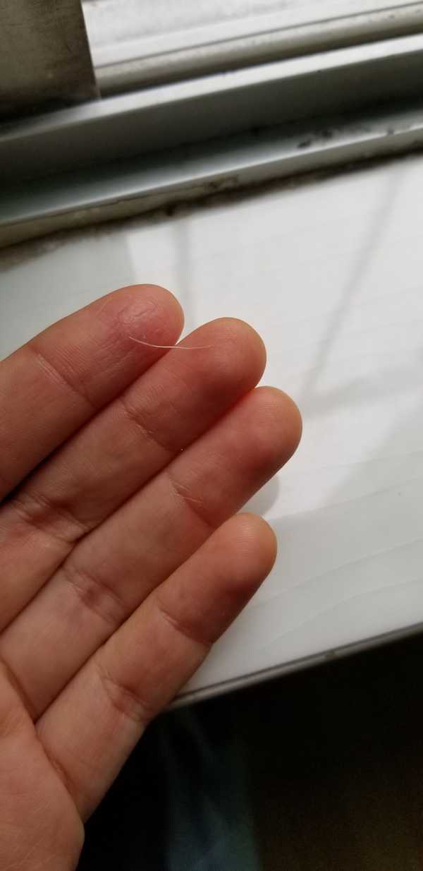 去医院取鱼刺是种什么样的体验?
