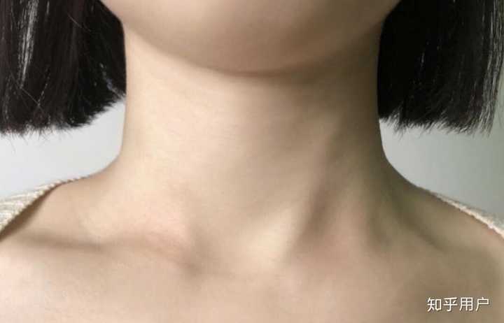 我才20岁,脖子又松弛皱纹有多,一圈圈很深的颈纹,怎么