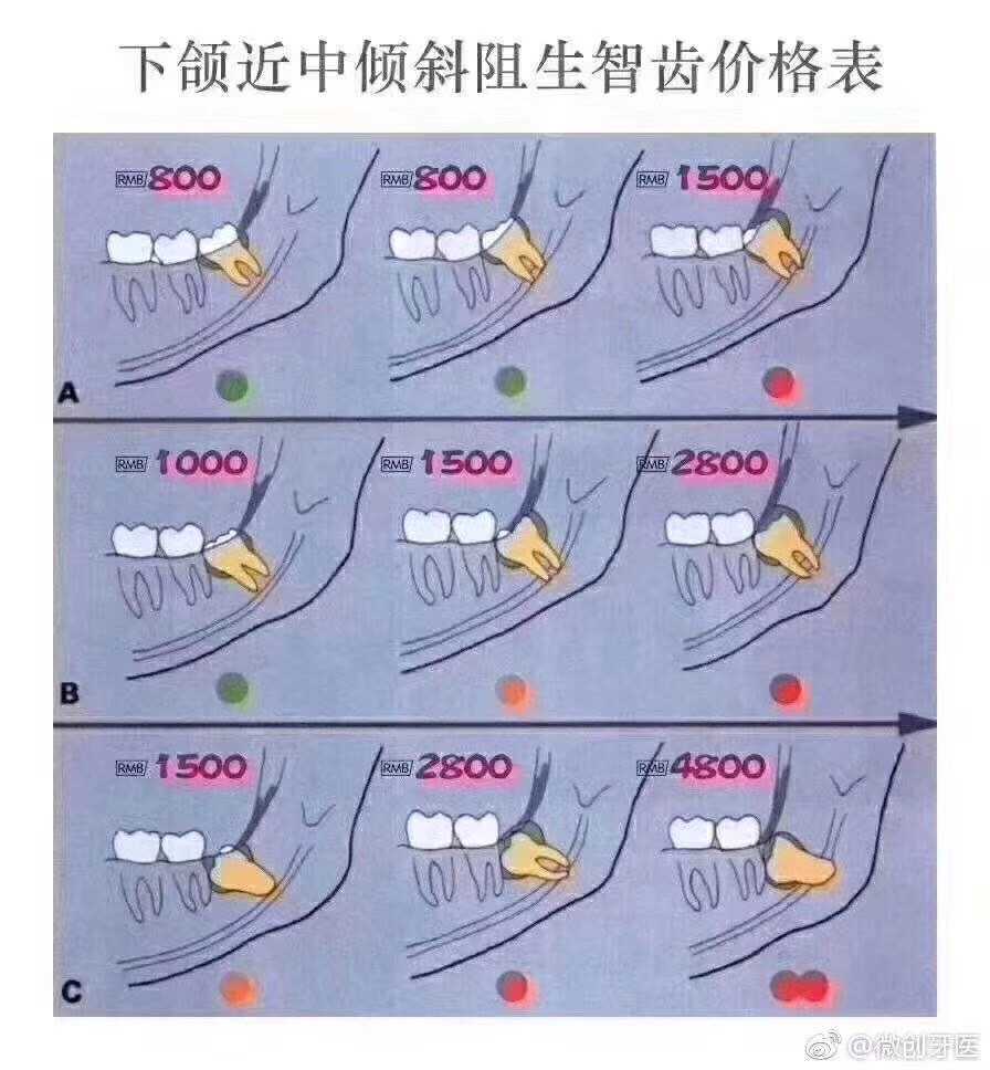 华西不住院的复杂牙3000以上吧,普通的700以上,水平的(横着长)1200