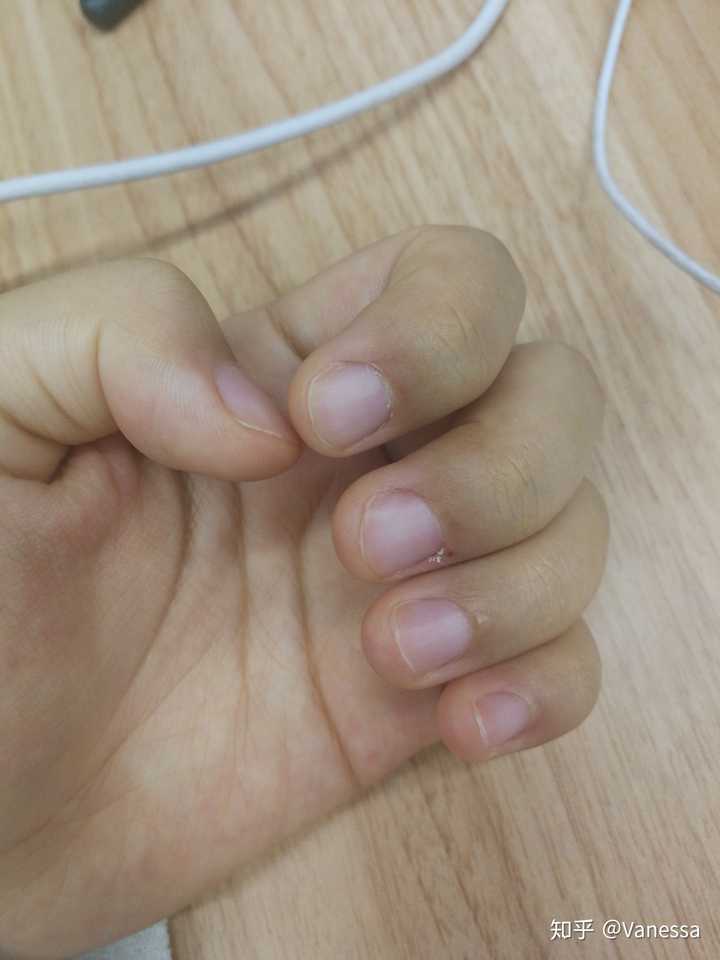 从小就喜欢啃指甲怎么办?