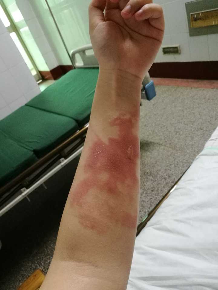 胳膊特别红当时… 还有我本来就粗包完了更粗的大腿 早知道烫伤的时候