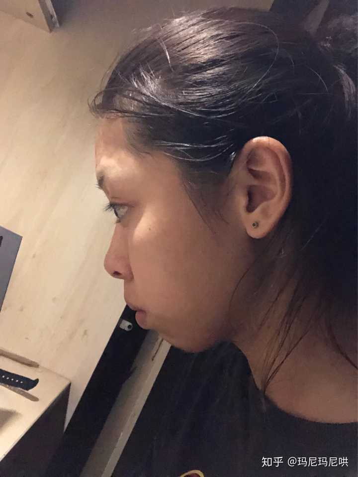 地包天可以通过口呼吸来缓解吗?