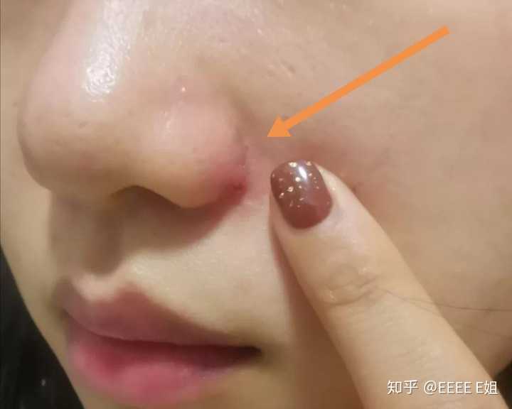 医生鼻翼手术 经验不足,没有考虑到鼻翼的生理结构,手术切口太直,位置