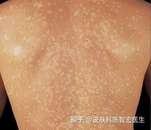 皮肤科陈智宏医生 的想法: 花斑癣 概念: 俗称汗斑,是由马拉色菌菌