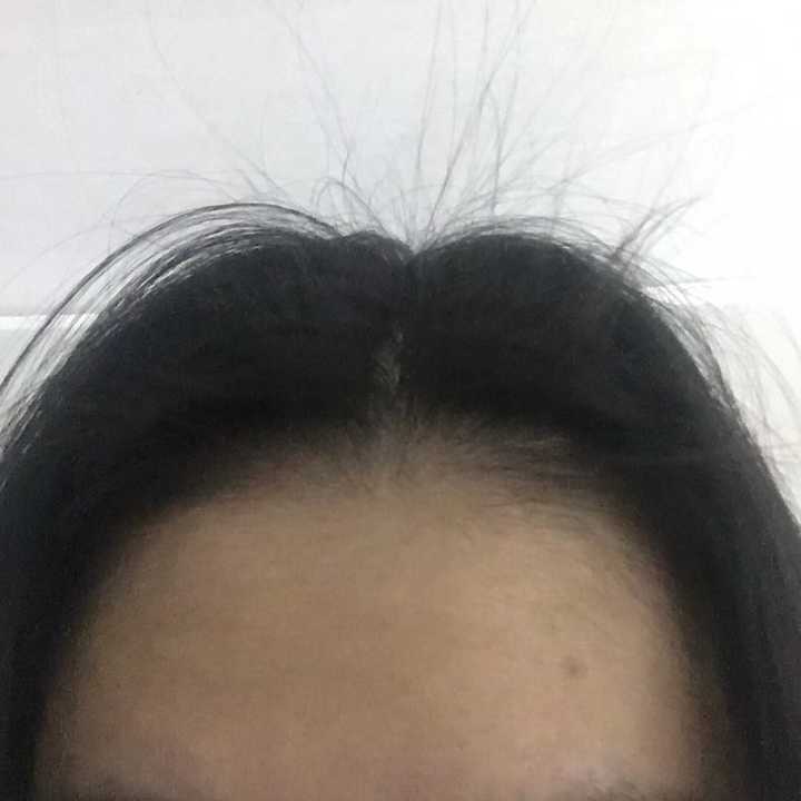 今年21岁,前额的头发快秃了,发现越来越严重了,咋办啊,还有救吗?
