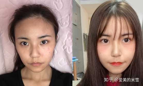 广州哪个割双眼皮的整形医院比较好,有没有割过的朋友