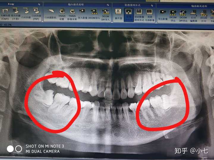 拔智齿需要多少钱?