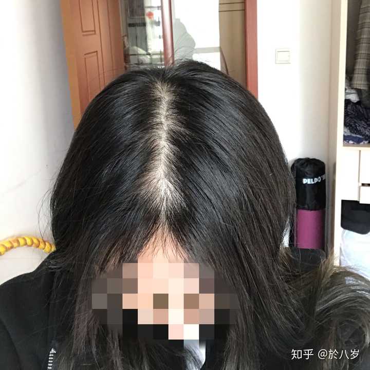 女生秃顶是怎样一种体验?