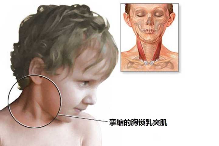 宝宝满月被查出患有先天性斜颈.