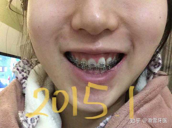 整牙失败是一种什么样的体验?