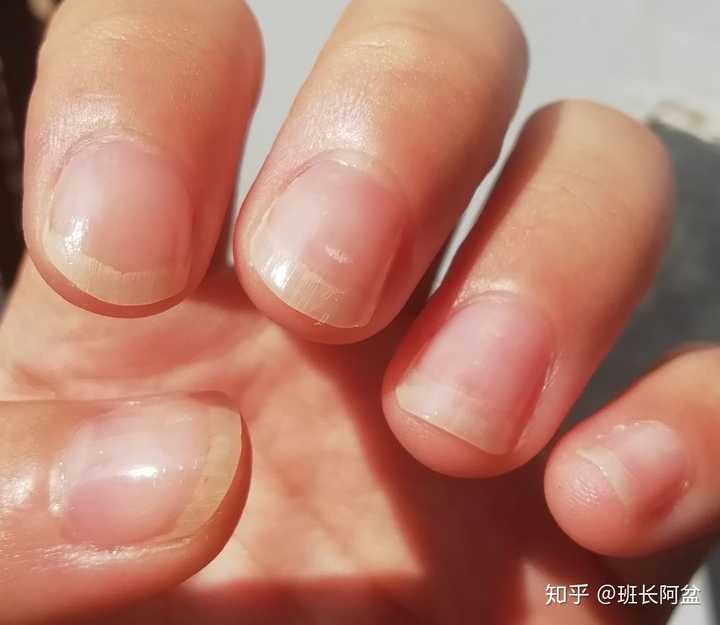甲床过短应该如何变长?