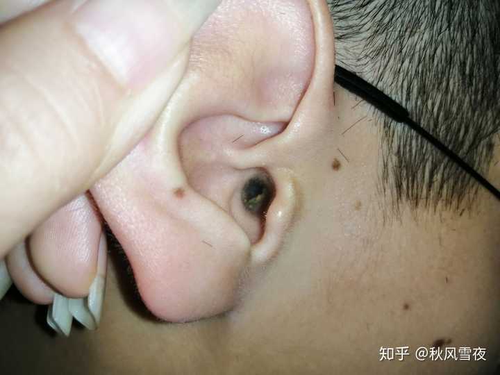 我男朋友的耳朵,好久没拔了,发现好多耳屎 他刚剪完头发我看的,哈哈哈