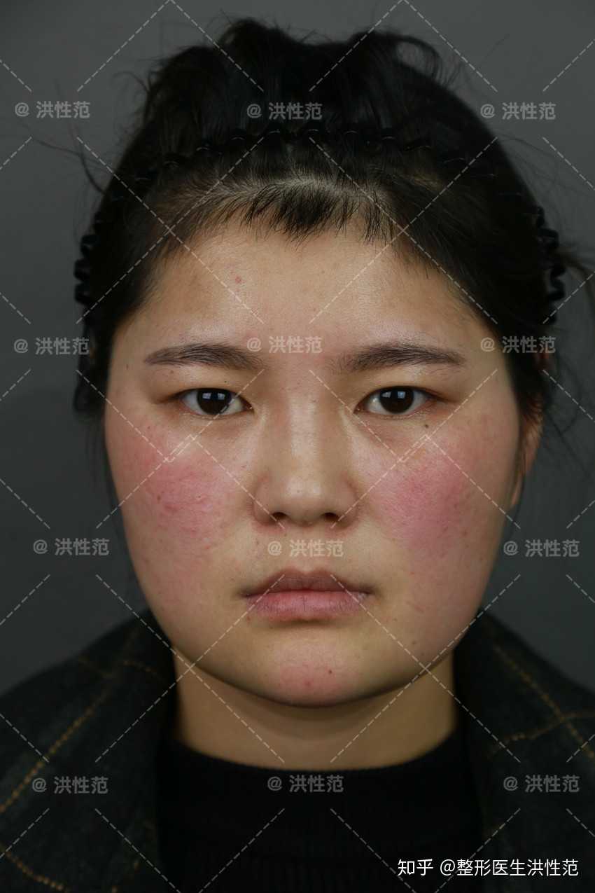 下颌角肥大下颌角肥大医学上称下颌角肥大或方脸畸形.