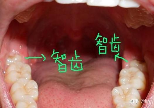 否则我们姑息养奸的话,智齿给我们带来的痛苦和损失会远远大于拔除