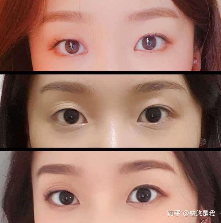 肿眼泡小内双适合做日式无痕吗?