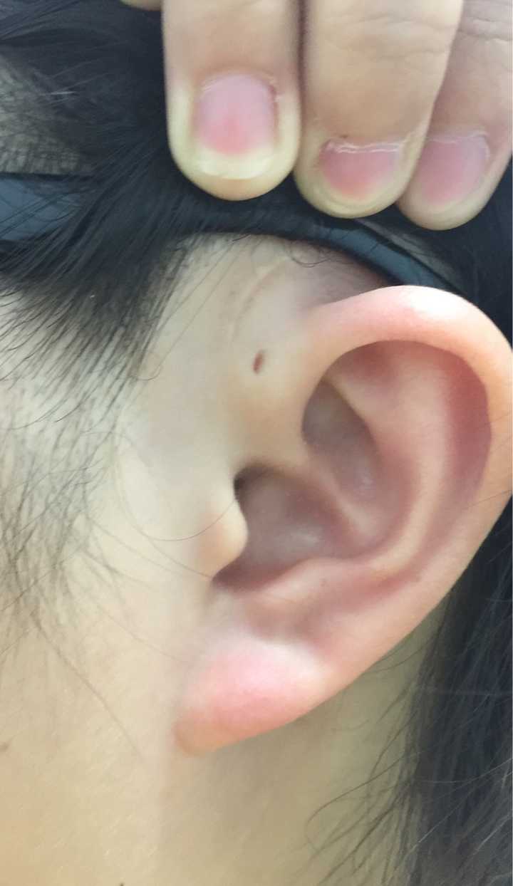 患有先天性耳前瘘管是一种怎样的体验?