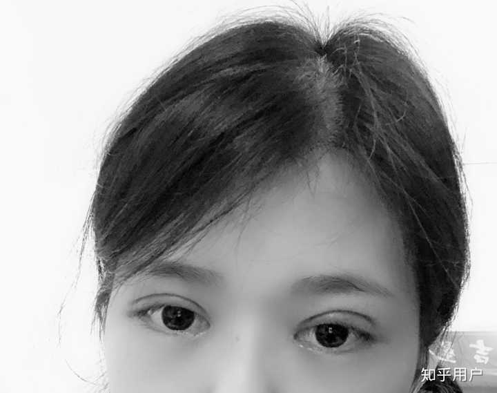 这是6个月的眼睛,右眼疤痕增生中间长了坨肉,中间就凸起了,显得线条很