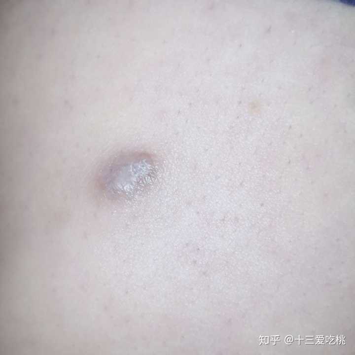 频繁长疖肿怎么办.