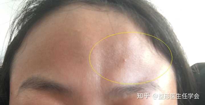 额头一侧凹凸不平,有什么改善的方法吗?
