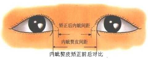 开眼角,眼睛变大是什么体验?