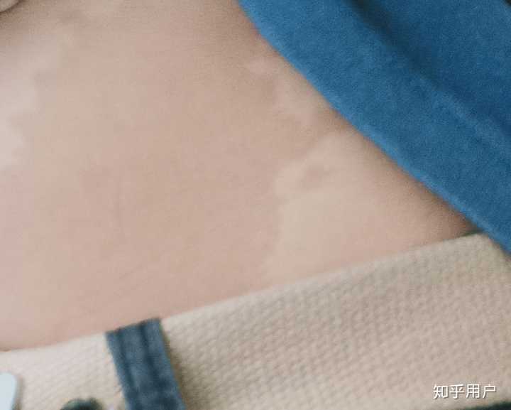 你见过什么特殊的胎记?