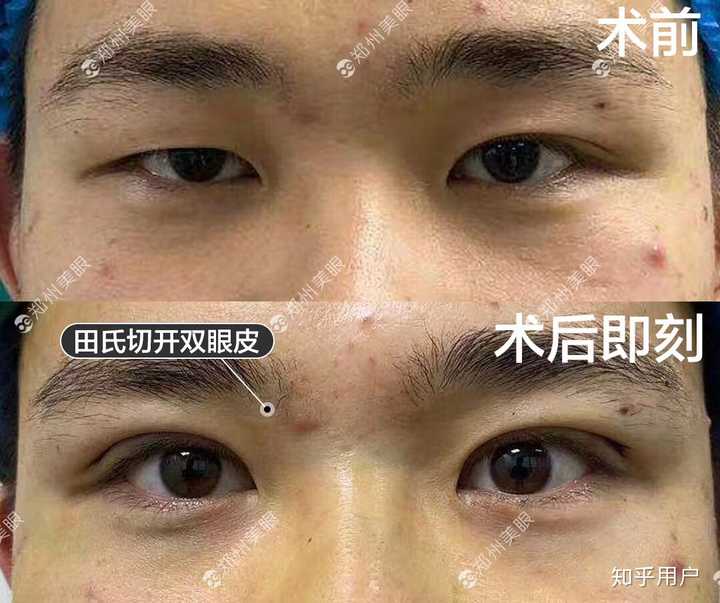 男生做双眼皮好不好?容易被看出来吗?