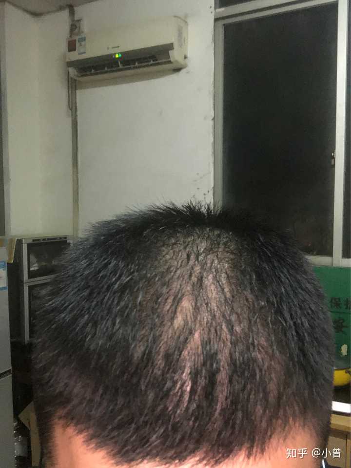 米诺地尔能不能只先用一小块头皮试用观察效果?