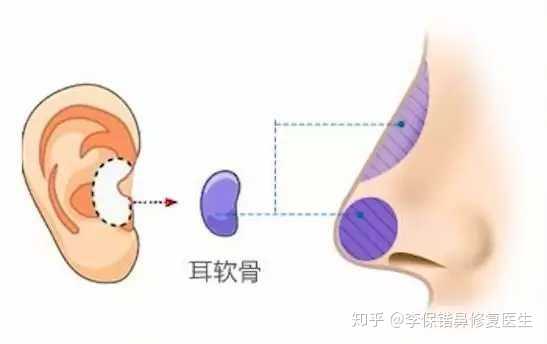 隆鼻用耳软骨和肋骨有什么区别