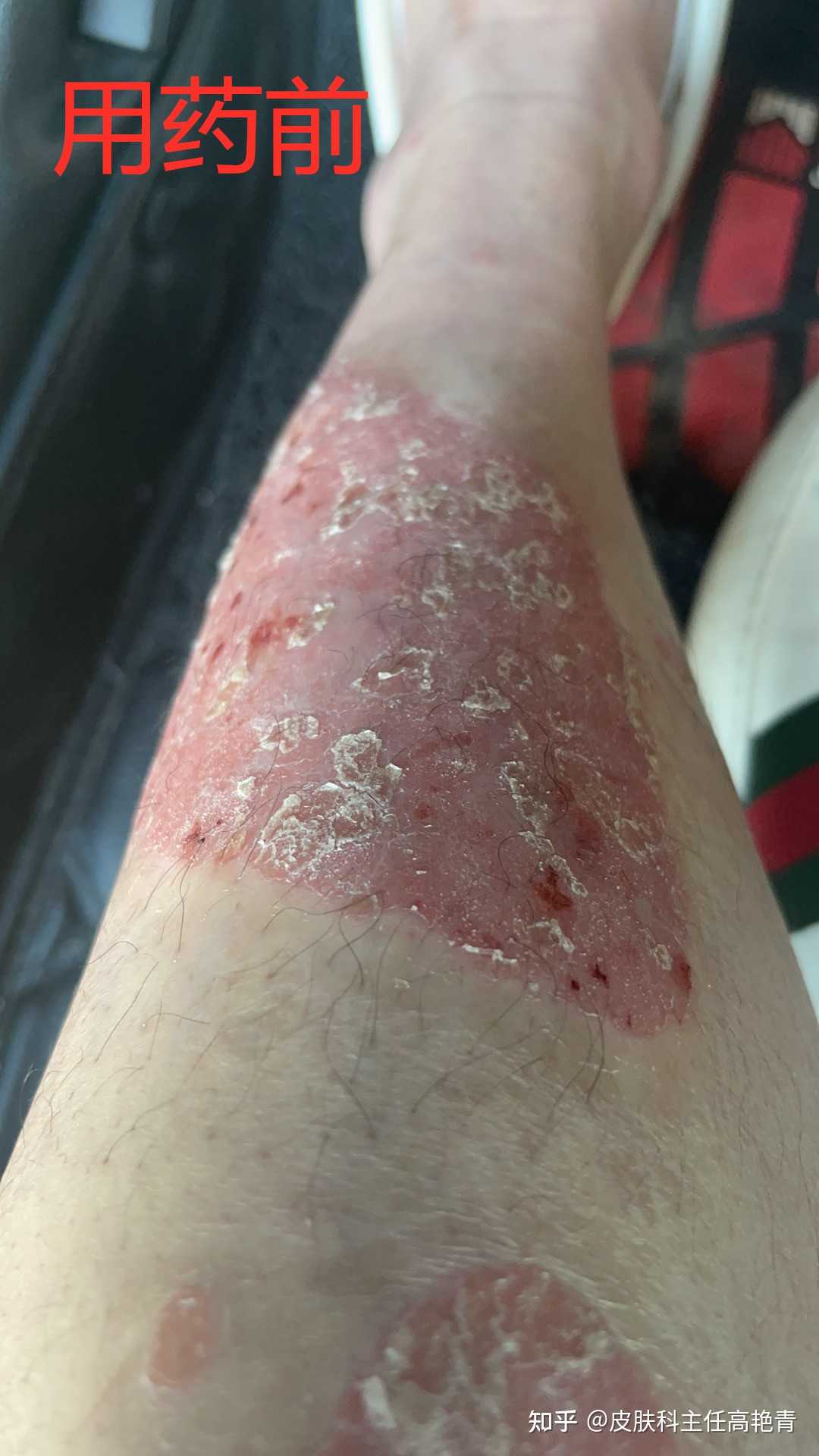 病例分享广东的黄先生患银屑病5年5年间试过很多方式治疗但一直反反复