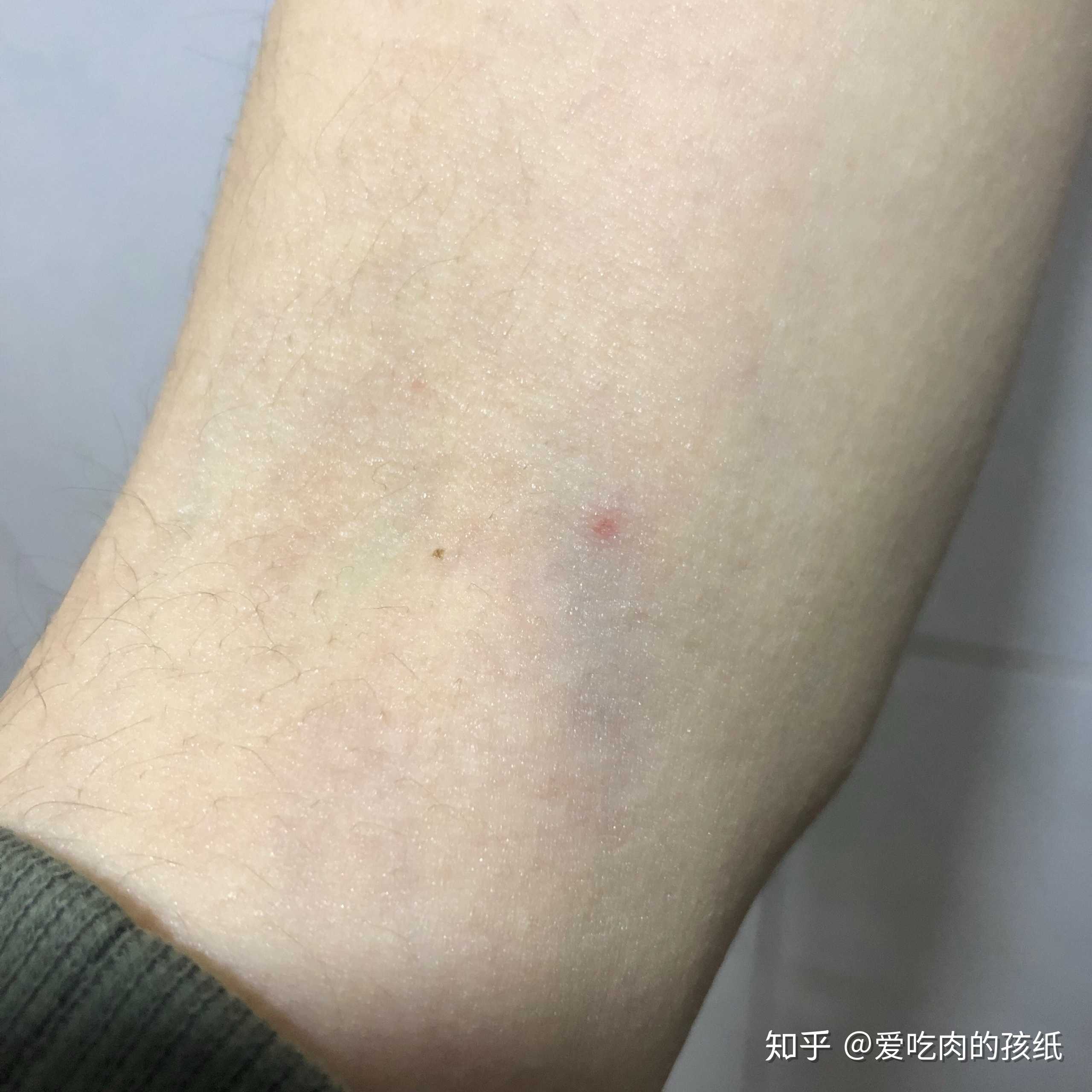 抽血肿掉的手臂