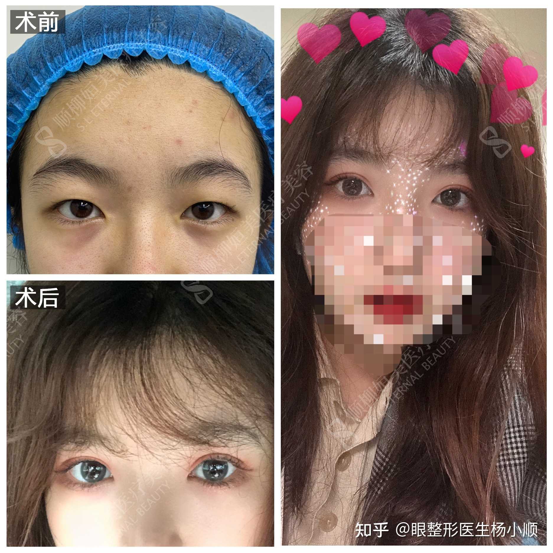 眼整形医生杨小顺 的想法 眼综合术后对比,一见钟情钟的不是情而是