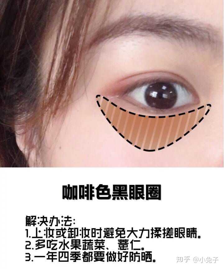 黑眼圈的生成原理?