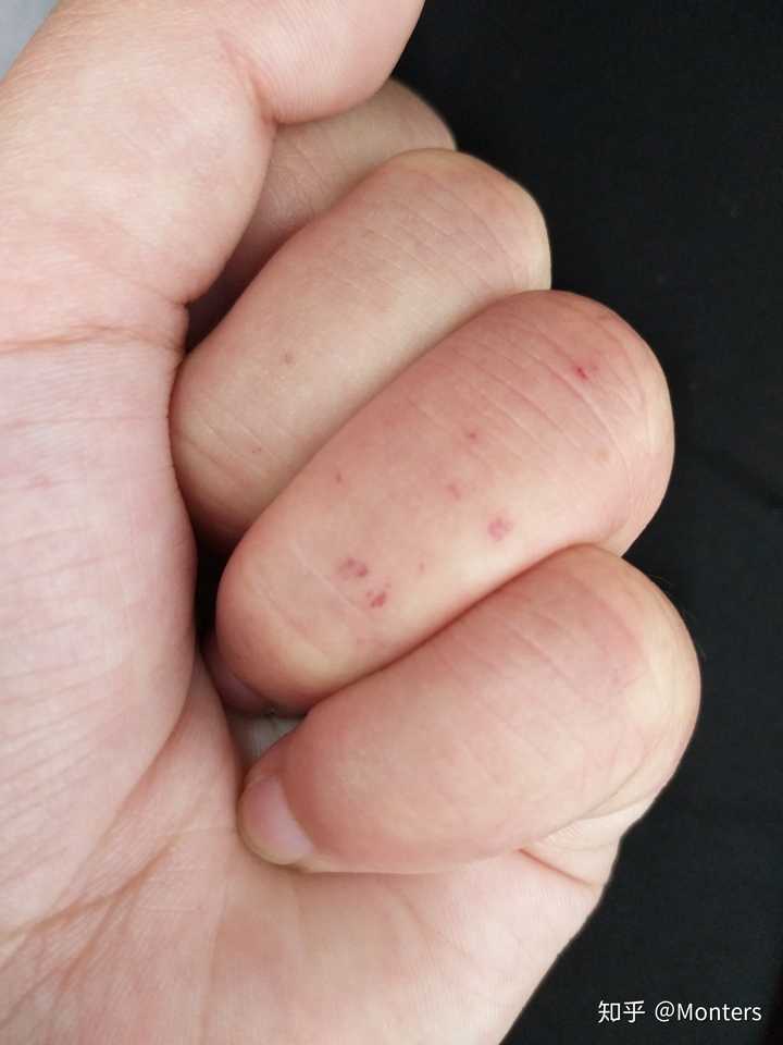 皮肤有许多红色血点,请问这是什么病?需要治疗吗?