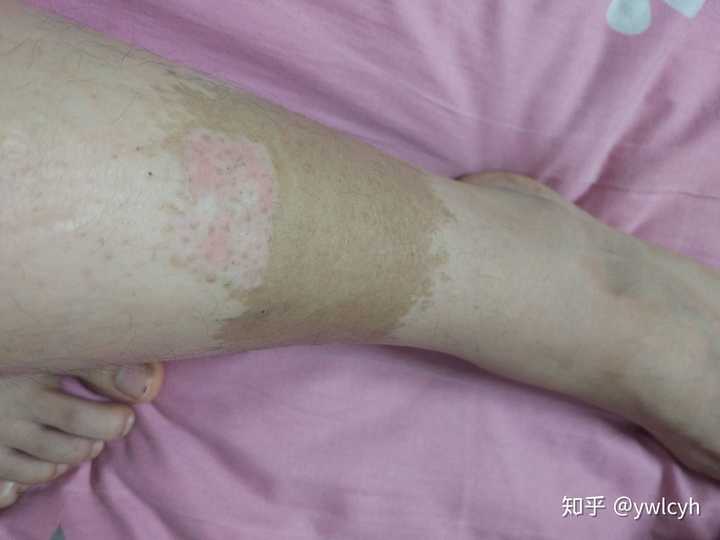 腿上有胎记夏天不能穿裙子怎么办?