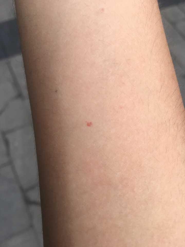 小的时候被虫咬了留下红印 不能消退 请问是什么虫 有