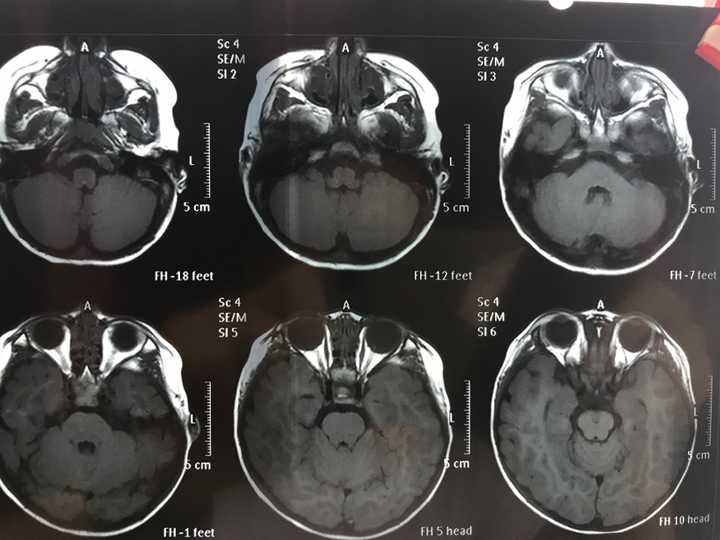 磁共振,双侧半卵圆中心及侧脑室后角旁白质异常信号,考虑扩大的血管