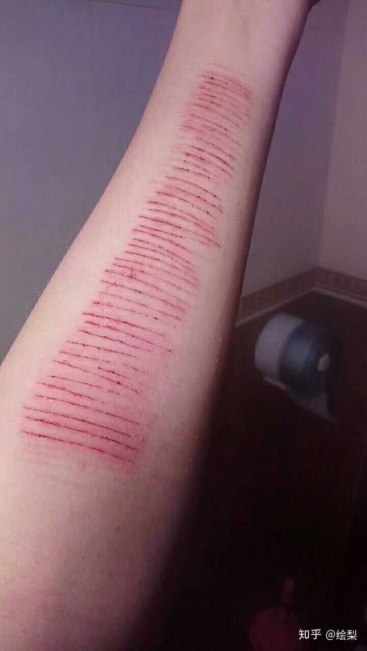 你有过自残的经历吗?