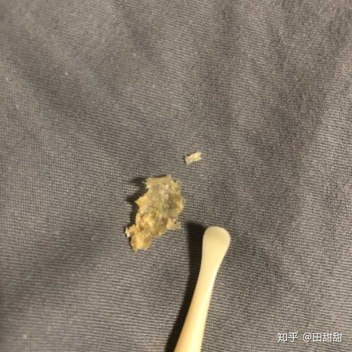 耳屎能大到什么程度?