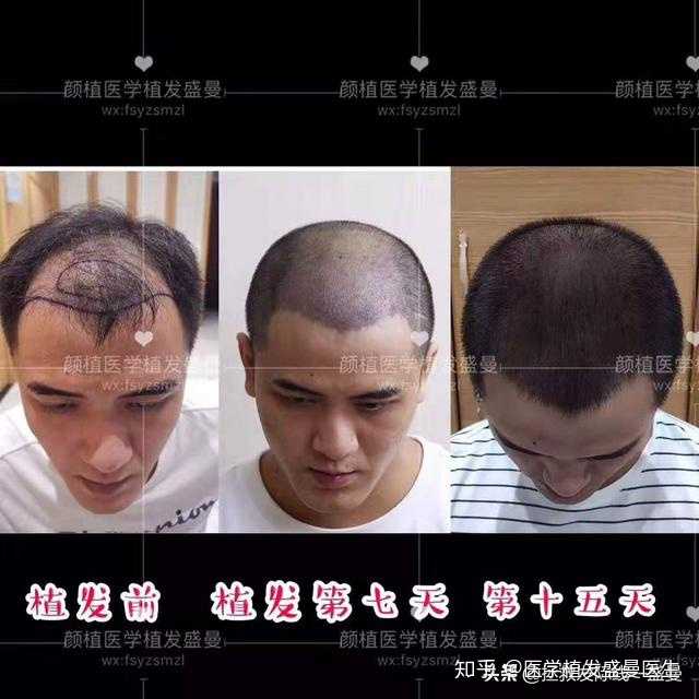 生长出来的头发细软,会继续慢慢脱落,而植发区提取的是后枕部的毛囊