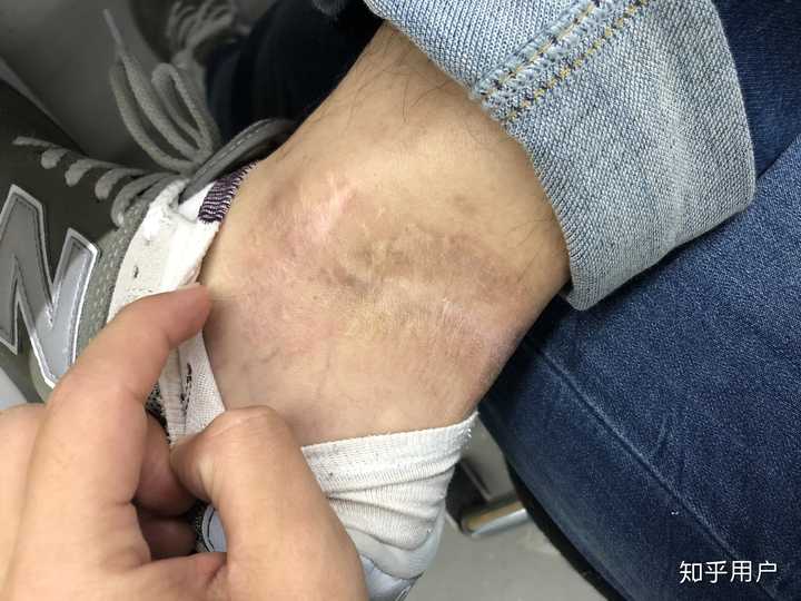 这就是我说的脚上的疤,缺了一块肉,而且还有一条大蜈蚣,是不是很帅.