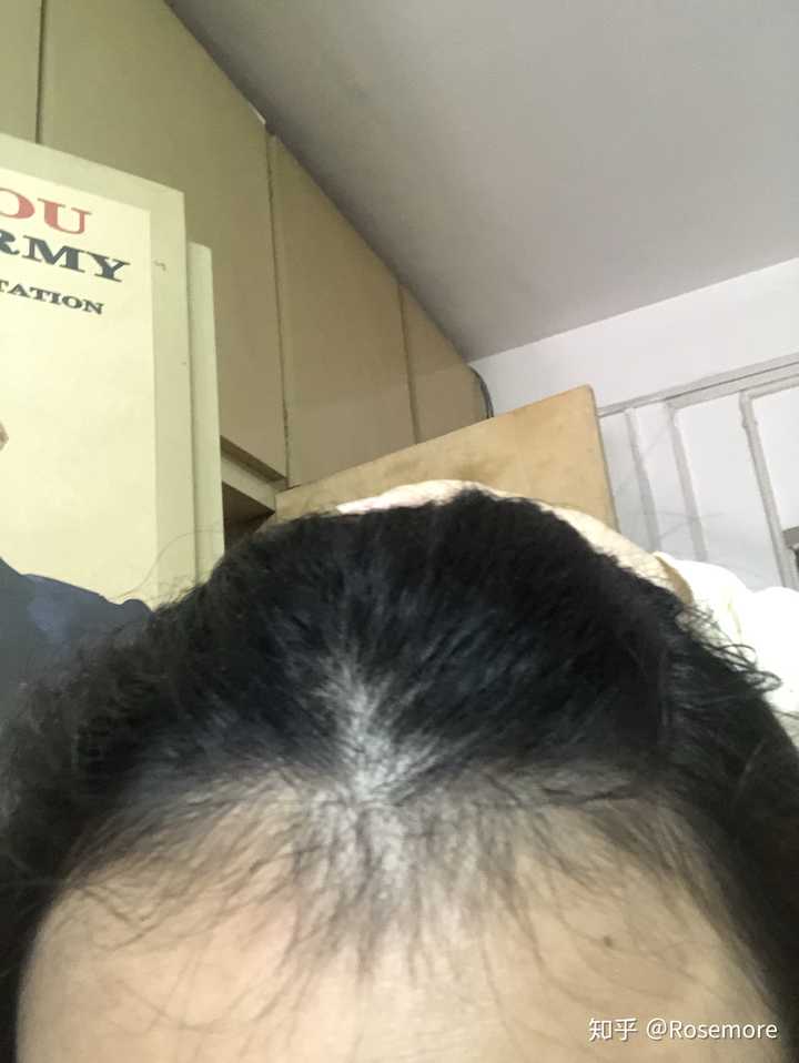 有人用过米诺地尔这种生发药物吗?有用吗?