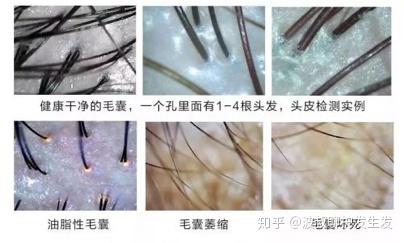 脂溢性脱发是头皮的皮脂腺内有大量的常在菌存在,3～4日后会
